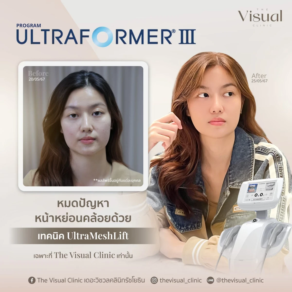 Program Ultraformer