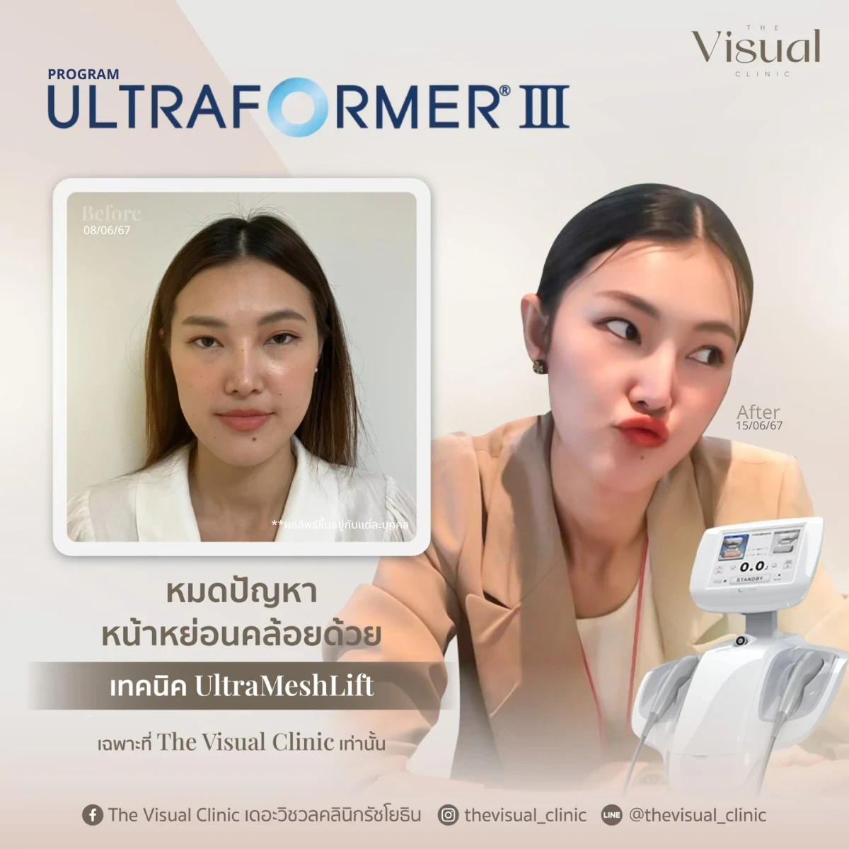 Program Ultraformer