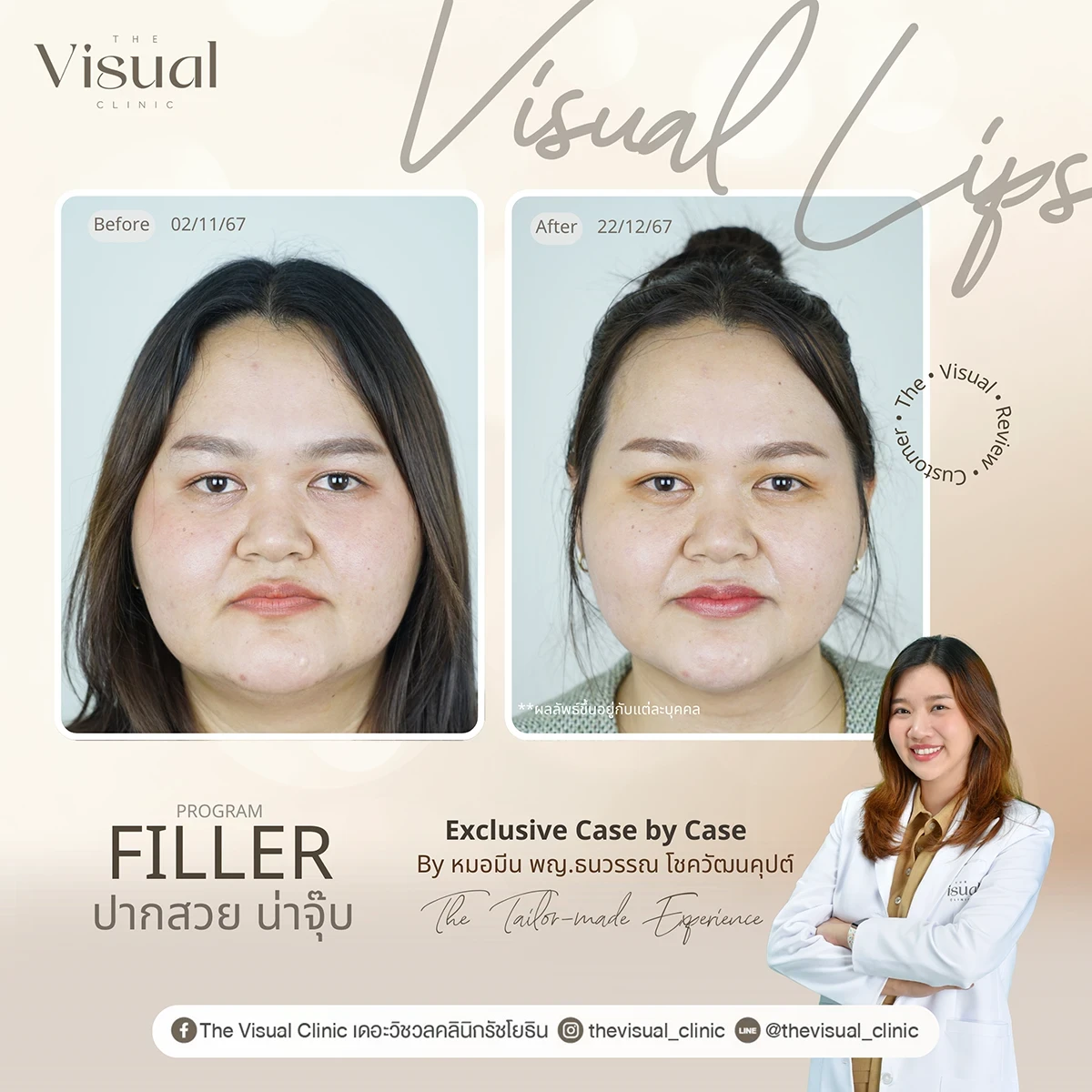 Lips Filler