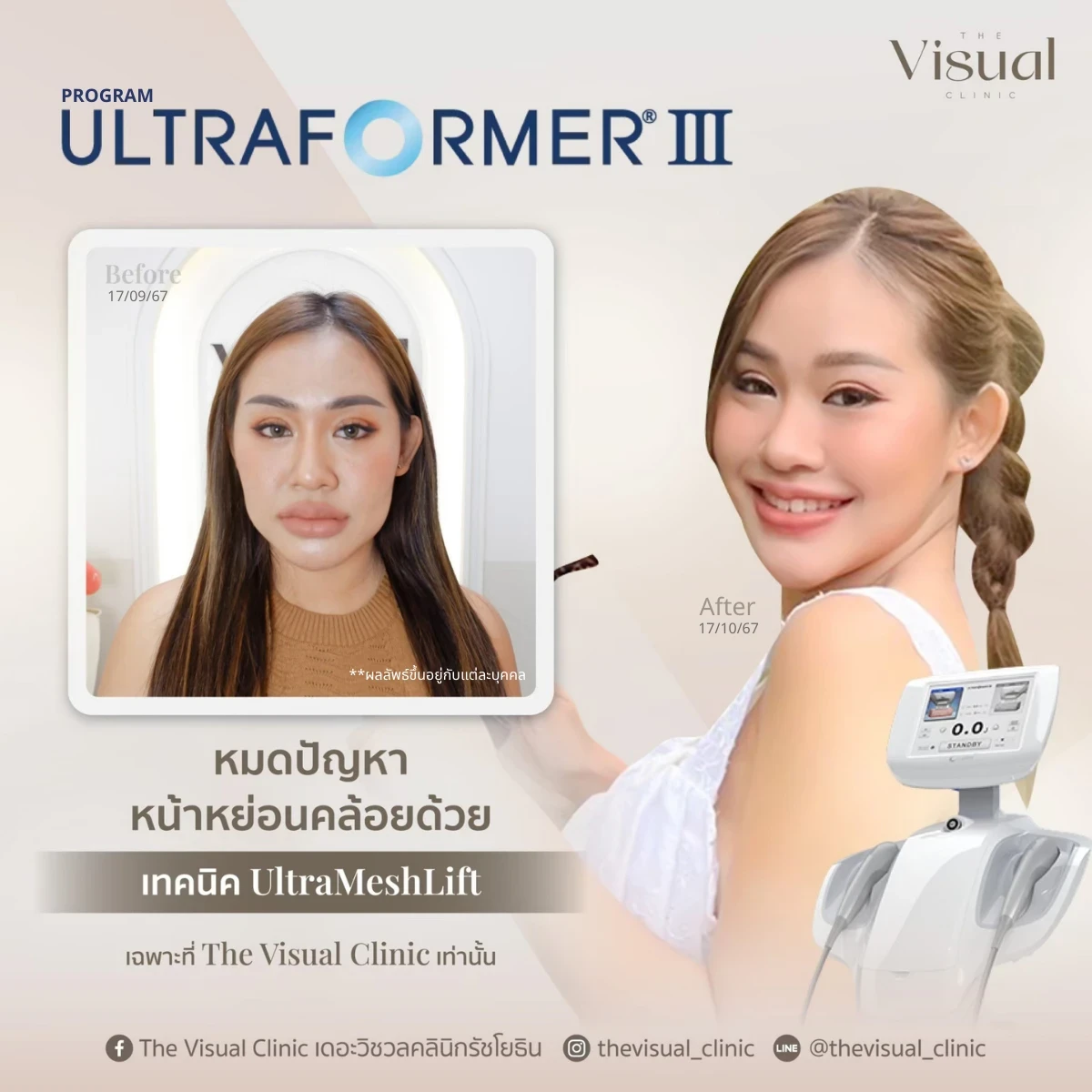 Program Ultraformer