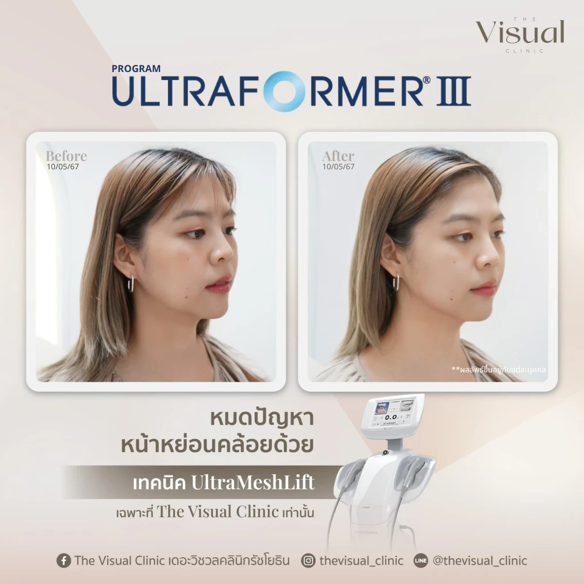 Program Ultraformer