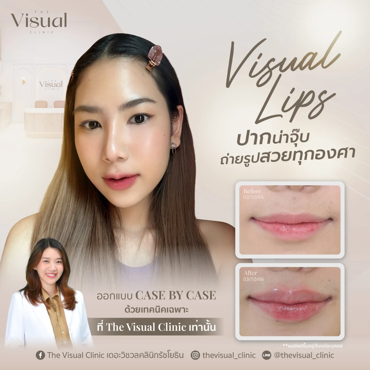 Lips Filler