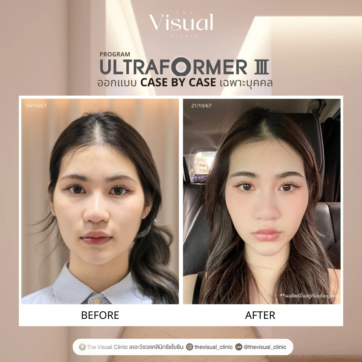 Program Ultraformer