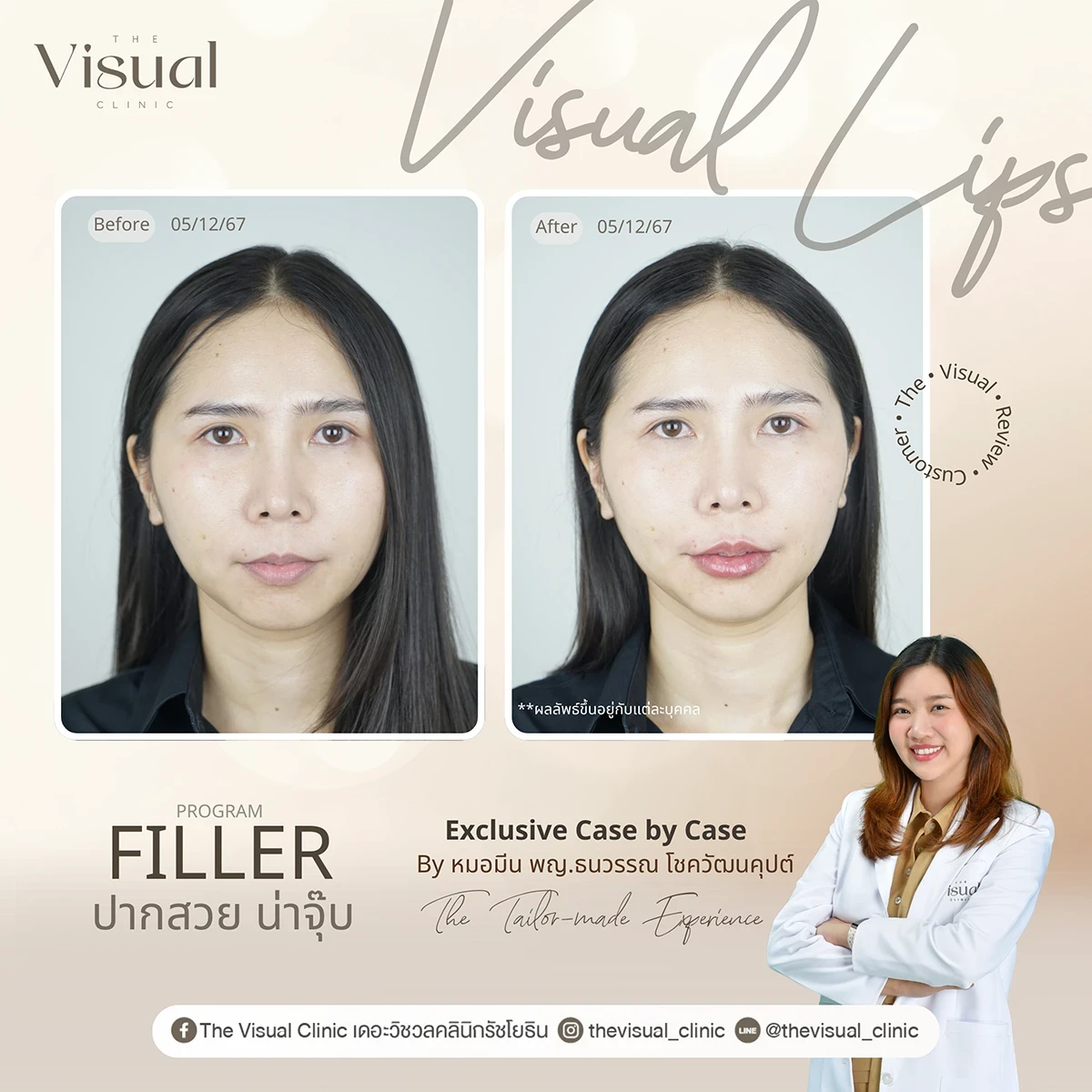 Lips Filler