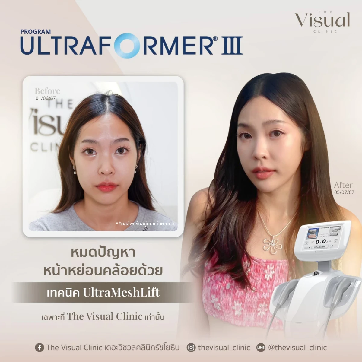 Program Ultraformer