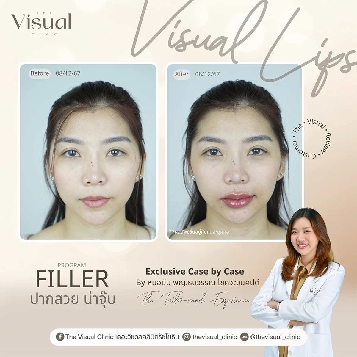 Lips Filler