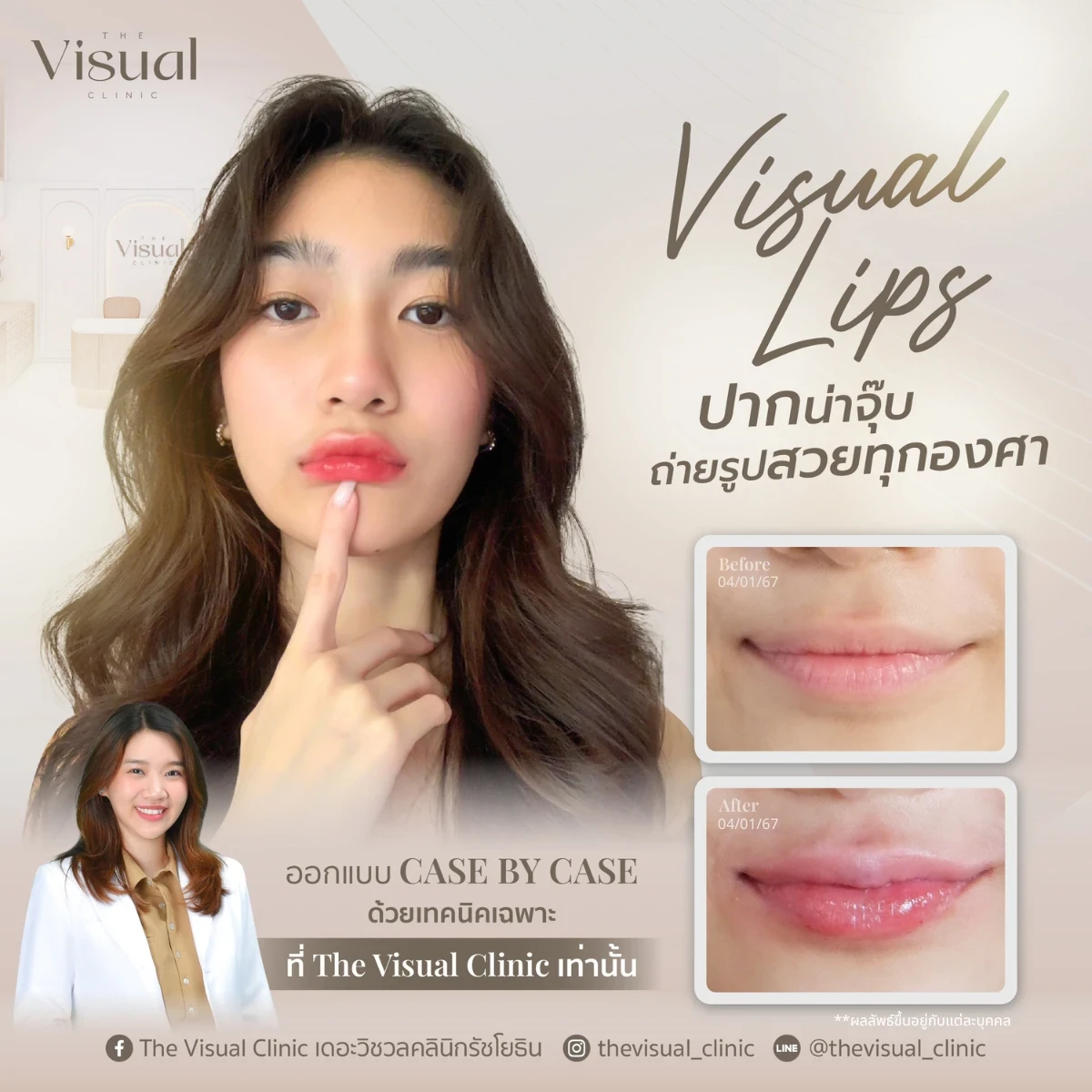 Lips Filler