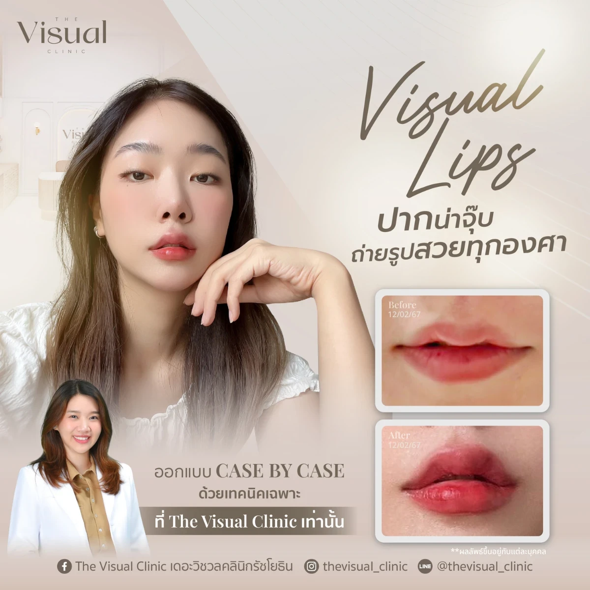 Lips Filler
