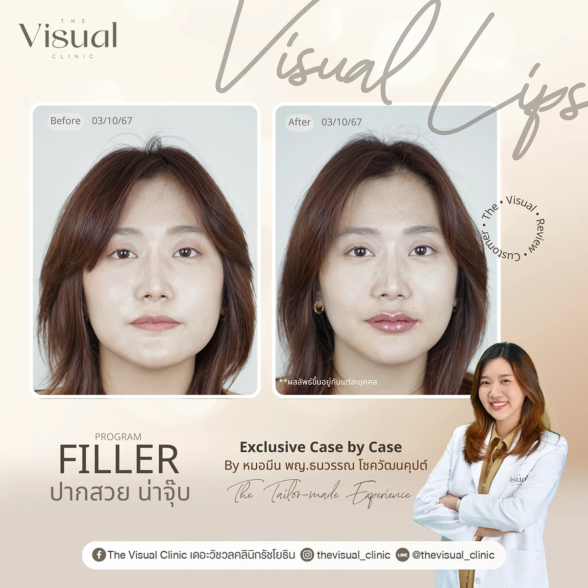 Lips Filler