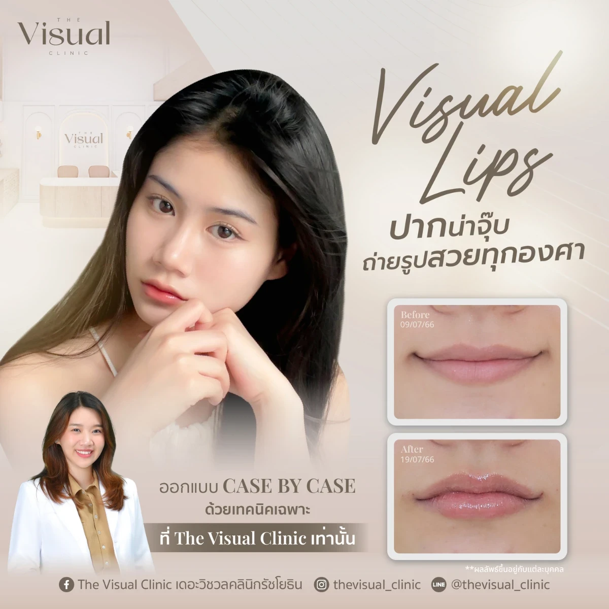Lips Filler