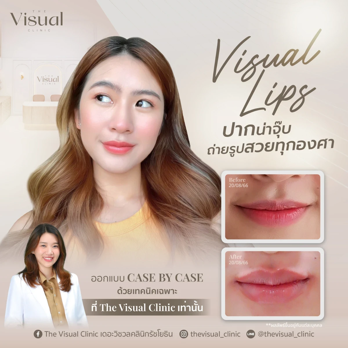 Lips Filler