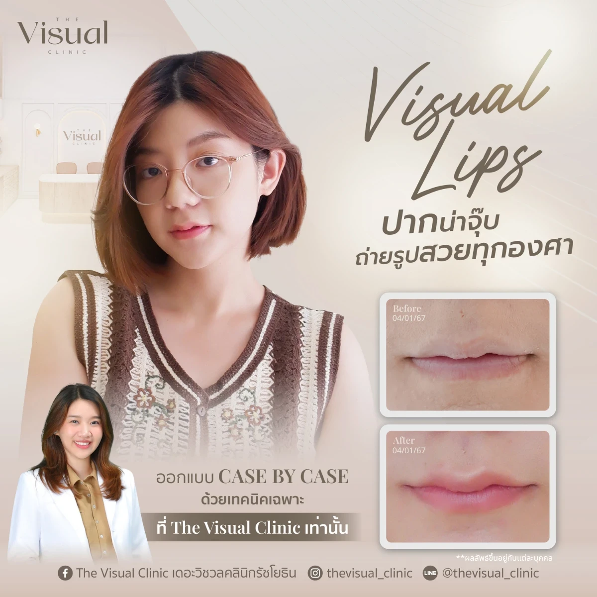 Lips Filler