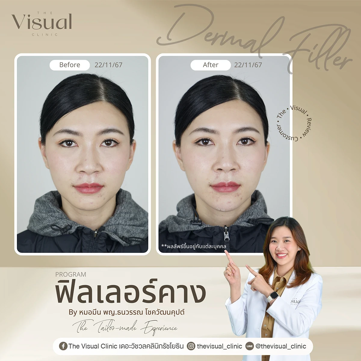 Chin Filler