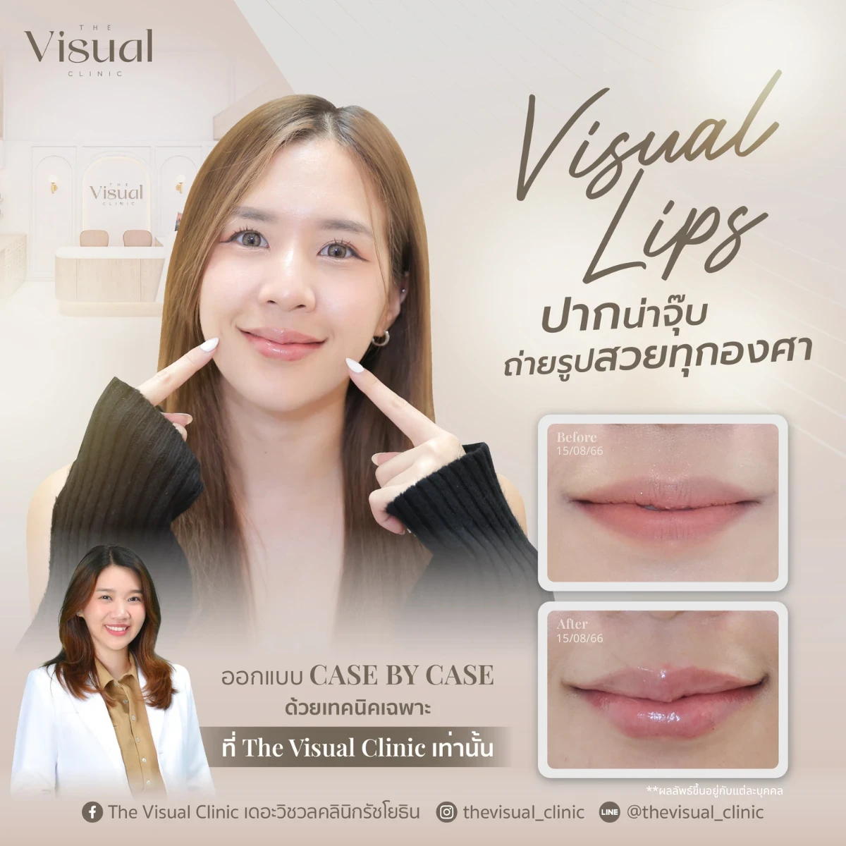 Lips Filler