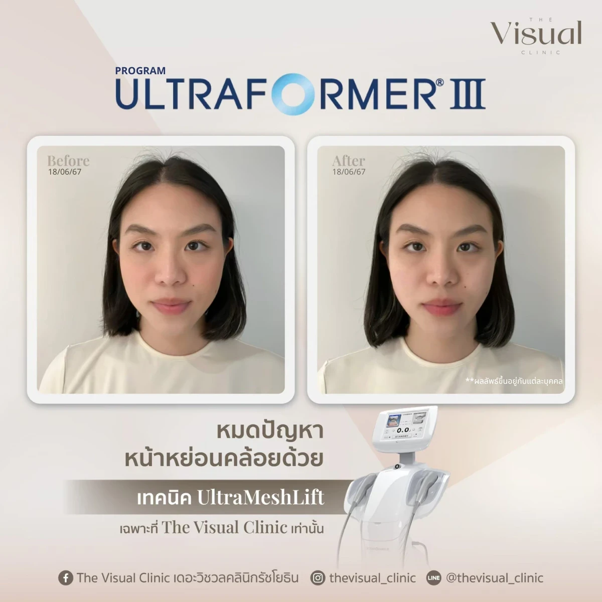 Program Ultraformer