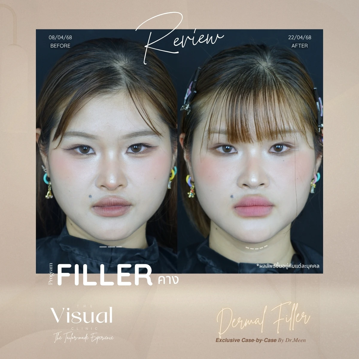 Chin Filler