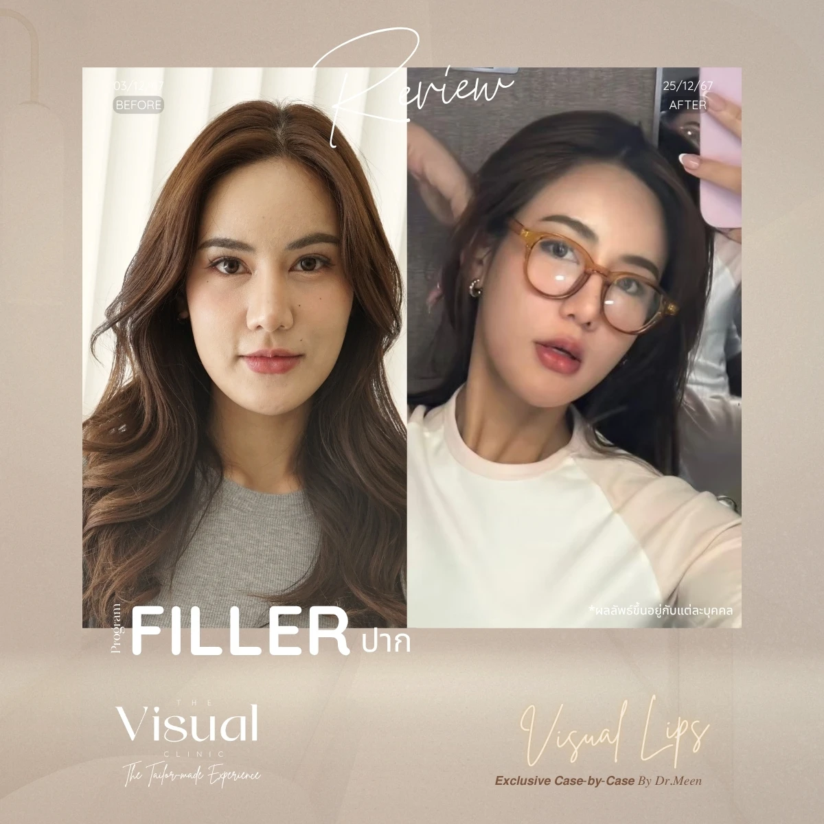 Lips Filler