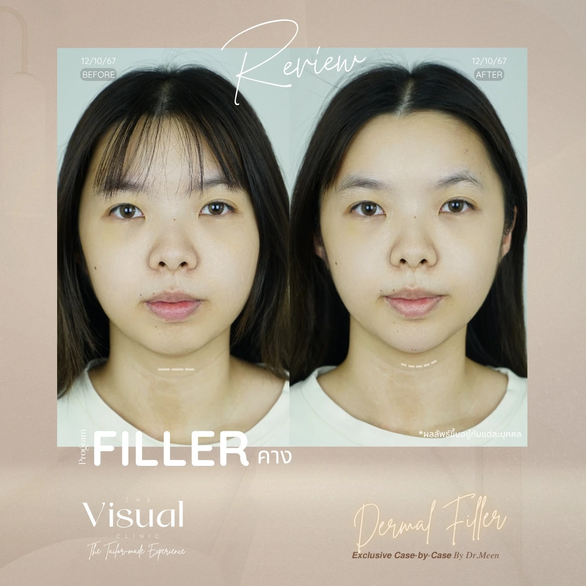 Chin Filler