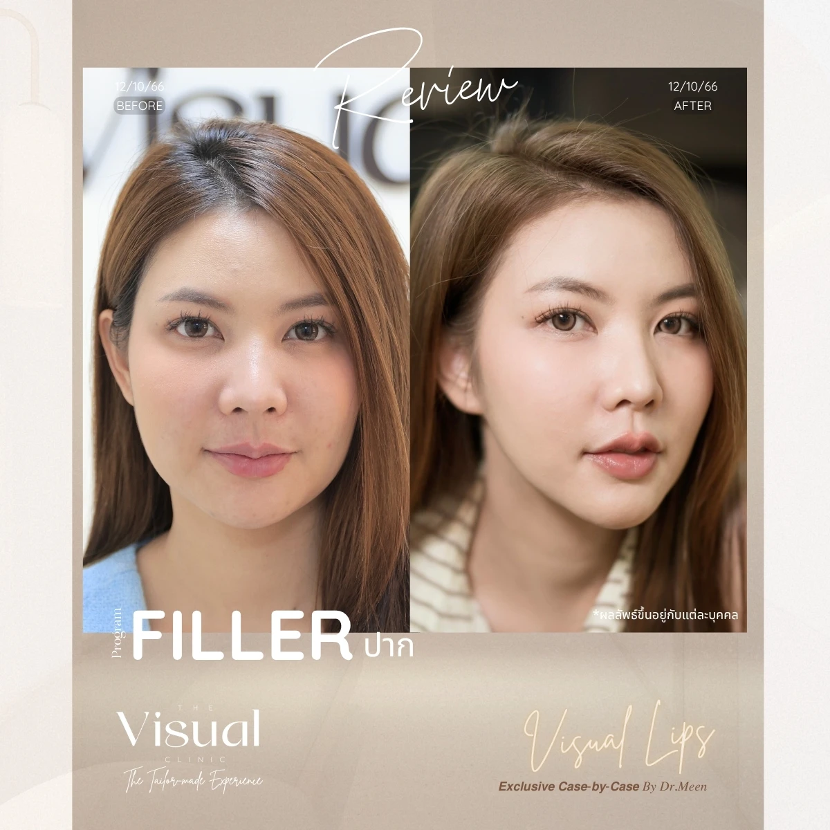 Lips Filler