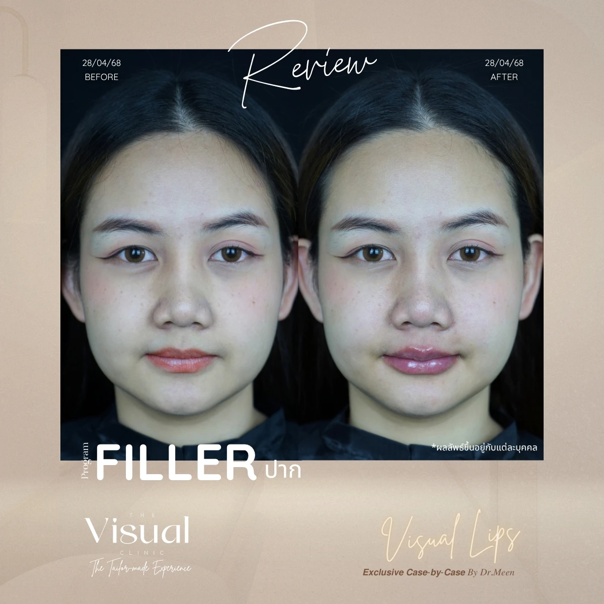 Lips Filler