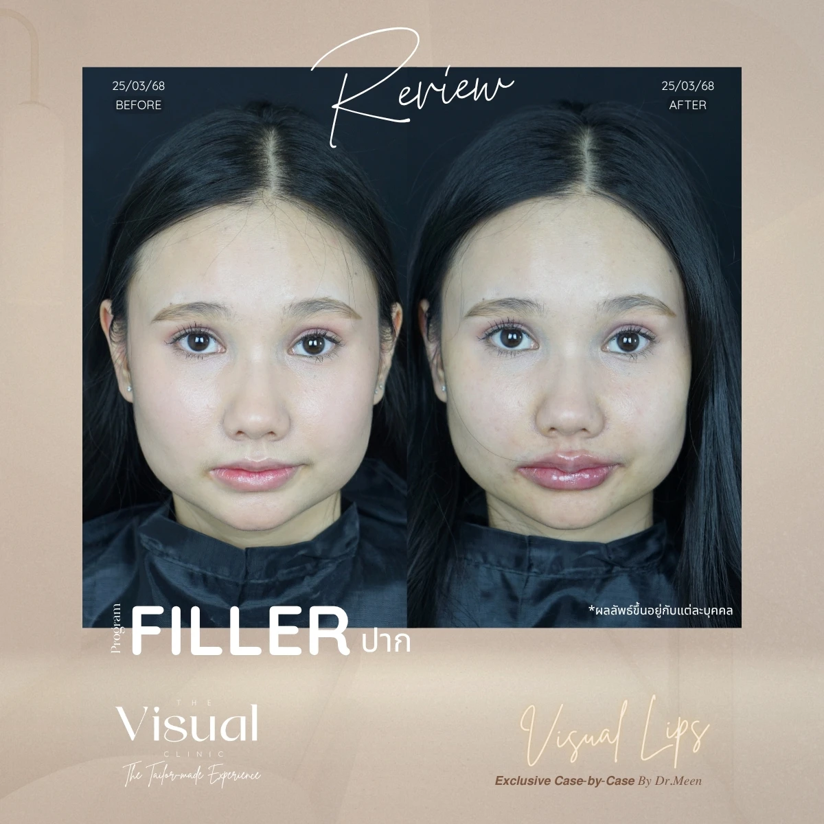 Lips Filler