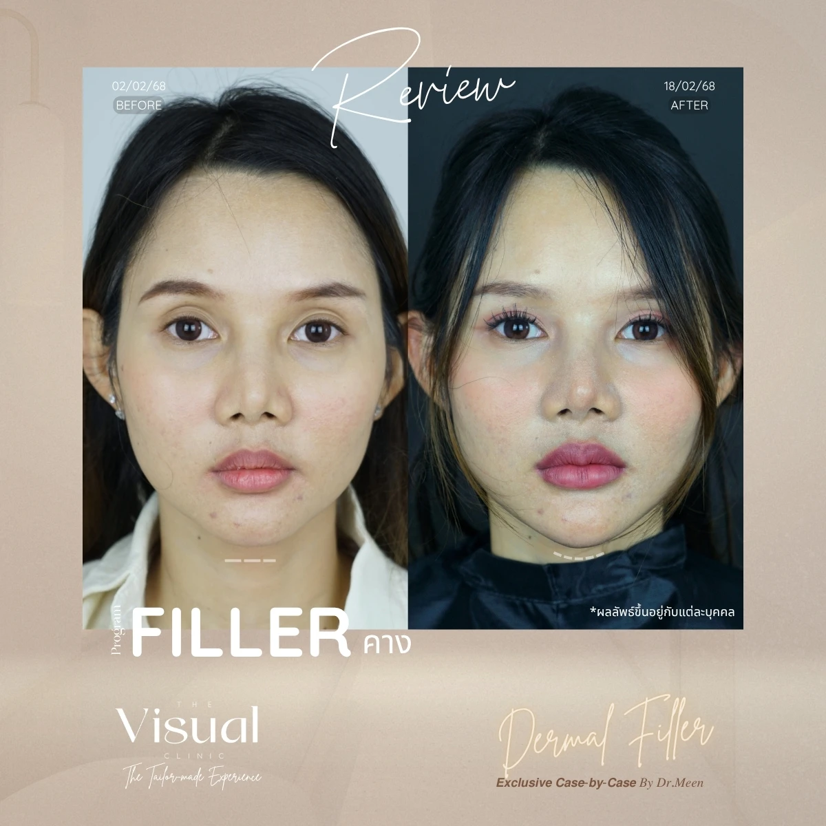 Chin Filler