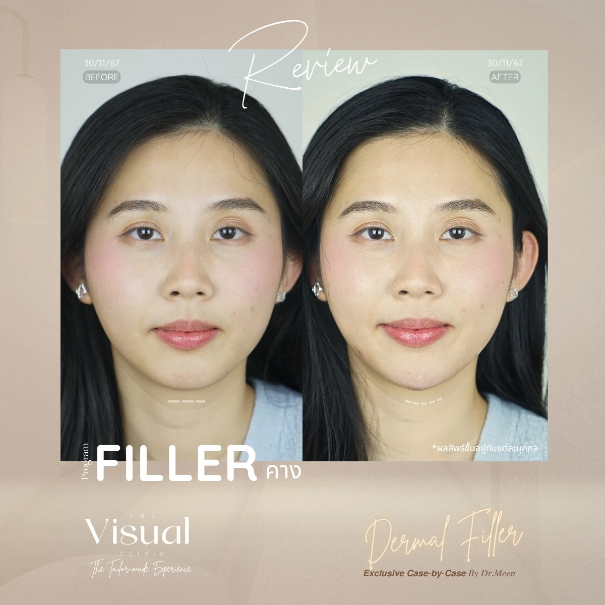 Chin Filler